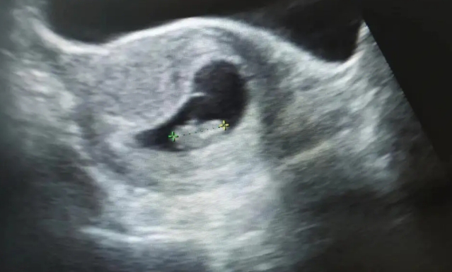 三代试管孕九周胚芽的正常大小
