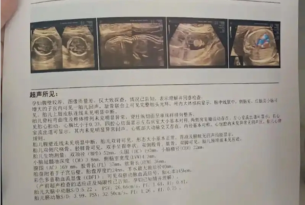 大排畸通过声音可以刺激孩子翻身