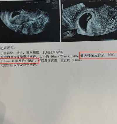 试管婴儿胎心胎芽还会胎停吗多久？多数胎停发生在见胎心后两周内