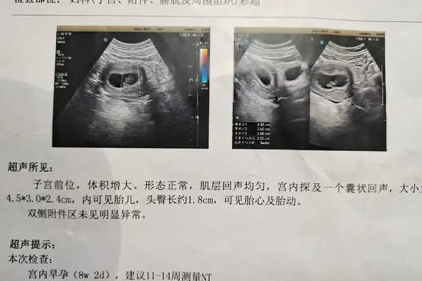 高龄孕妇怎么通过nt单子最准确地看出是男宝还是女宝呢？