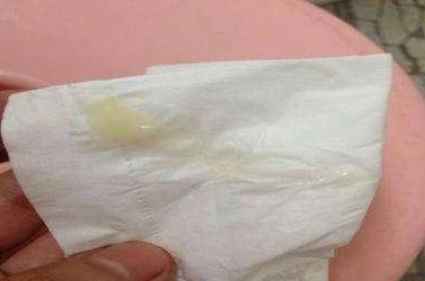 请问怀孕晚期正常的分泌物图片是什么样子的呢？