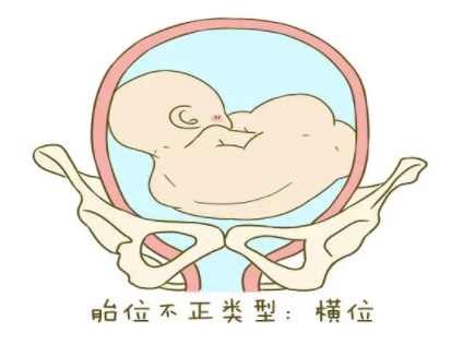 孕妇横位是怎么造成的.png