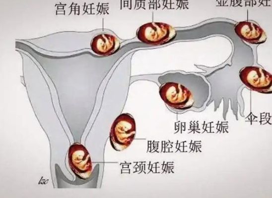 着床晚的胚胎在子宫里忙啥？备孕32天查不出怀孕的真实经历