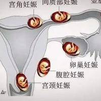 着床晚的胚胎在子宫里忙啥？备孕32天查不出怀孕的真实经历