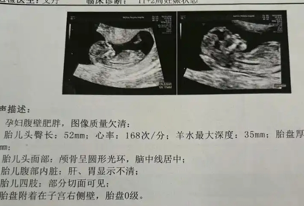 nt检查和唐筛可以分开检测