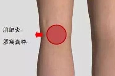 试管移植后腿酸软无力怎么回事？多半是这三个原因