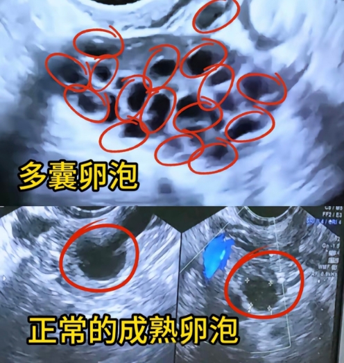 卵泡大于12个就一定是多囊