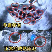 卵泡大于12个就一定是多囊?判断多囊的标准不止卵泡