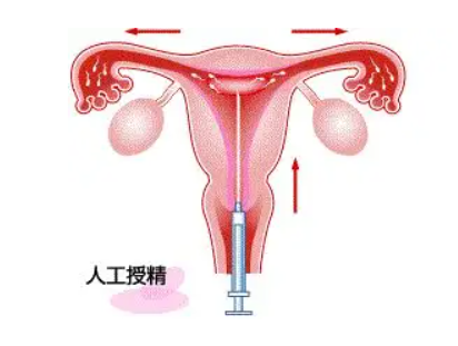 什么是体外受精，和试管婴儿的区别在于？
