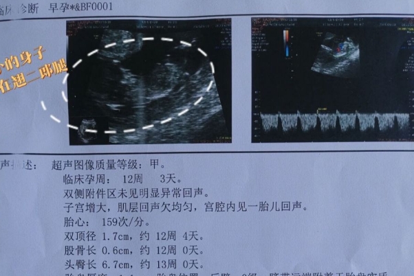 nt值与胎儿智商没有直接关系