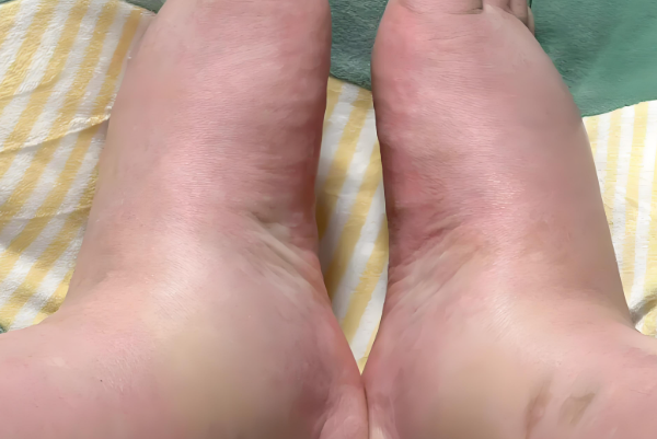 孕期脚肿需警惕排尿次数少