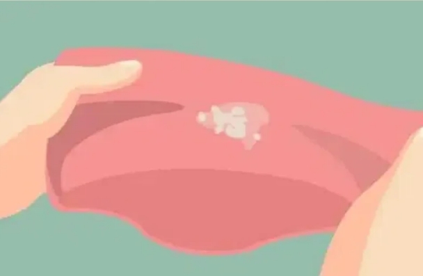 妇科霉菌可以用唑类抗真菌药物治疗