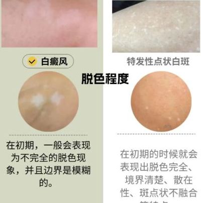 白点癫风会不会隔代遗传?先别急着怪祖辈