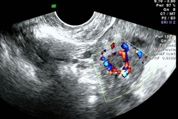 卵巢右侧正常能进行试管促排