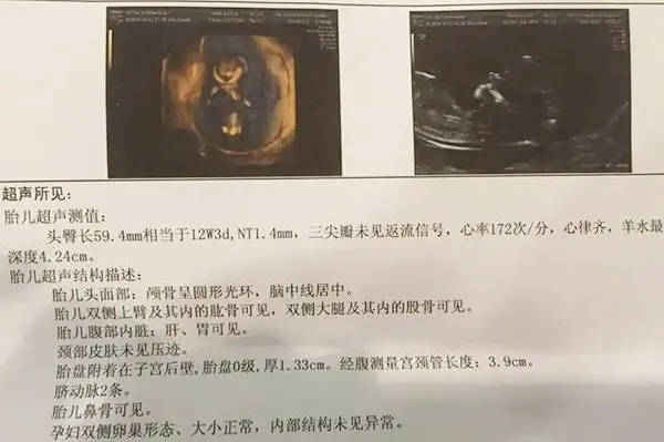怀孕12周可以通过头臀长度来看胎儿是男还是女吗？