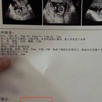 美国试管要多少钱一个？费用价格攻略与8笔开销明细