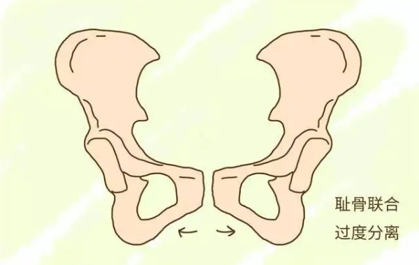 在走路时会导致耻骨联合部位受力增大