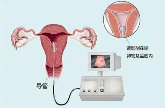 小手指自测输卵管通畅