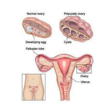 多囊卵巢可以怀孕吗？可以自愈吗？
