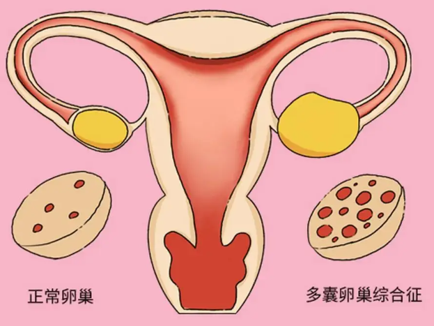 多囊卵巢会影响生殖系统健康