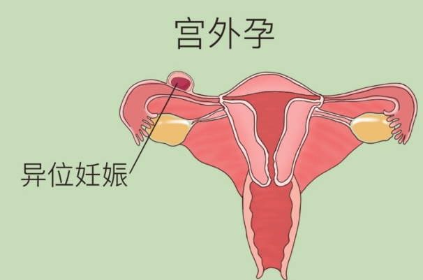 异位妊娠验孕棒是可以验出两条杠