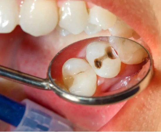 孕期出现牙齿问题不建议治疗