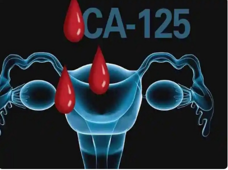 CA125升高可能是良性肿瘤