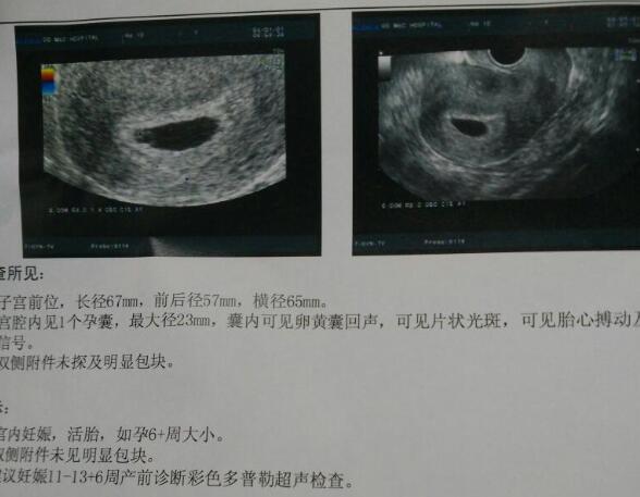 胎盘异常会影响胎心出现