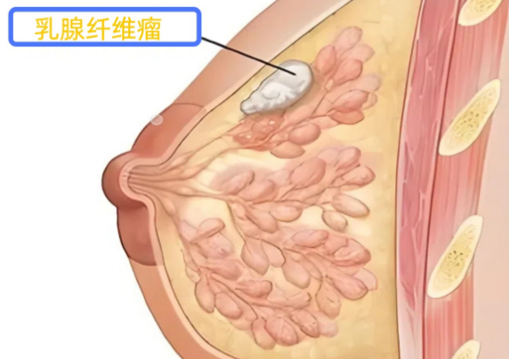 乳腺纤维瘤最怕三种运动