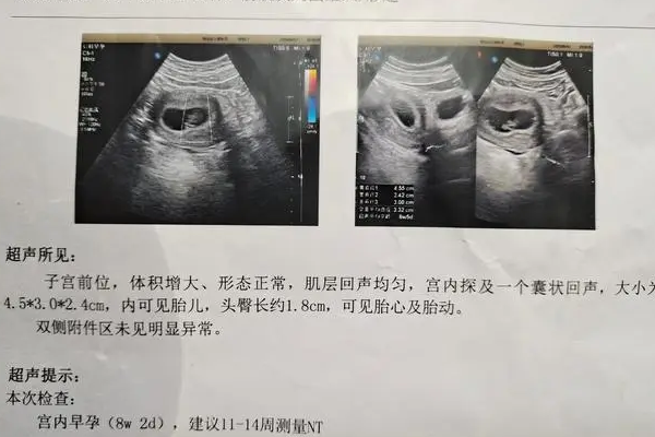 为何试管怀孕后nt检查显示的受孕时间会小于实际孕周呢？