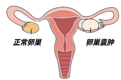 卵巢囊肿不能吃的水果 卵巢囊肿不能吃的水果