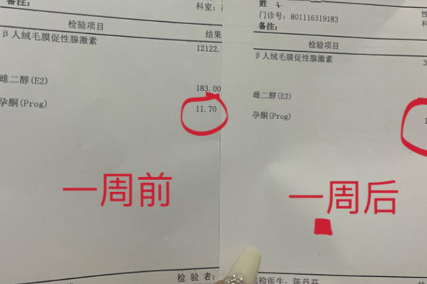 孕酮低不代表胎停
