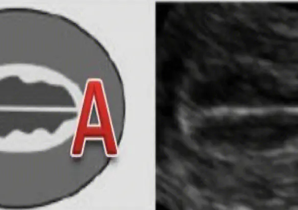 移植前子宫内膜容受检查显示为A型，你需要知道的三个关键点