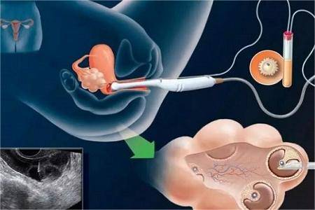 胚胎移植后会出现早孕反应