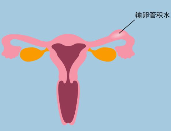 输卵管积水建议做钳夹术