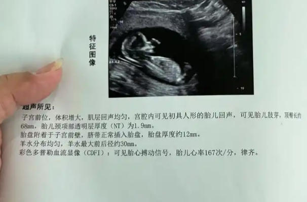 nt值无法判断胎儿性别