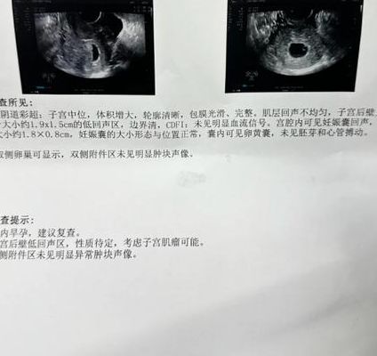 孕囊越圆=胚胎质量越好？别被形状直觉骗了，早孕评估得看多维指标
