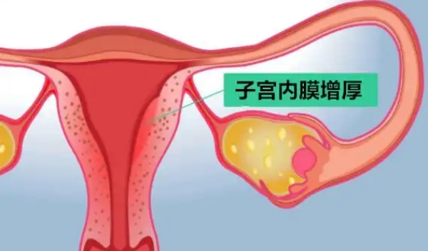 子宫内膜增生能做试管婴儿