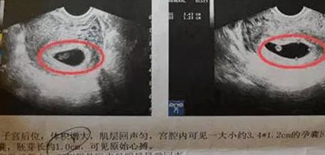 怀孕梦见西瓜？一次试管多少钱？过来人帮你梳理5笔开销明细
