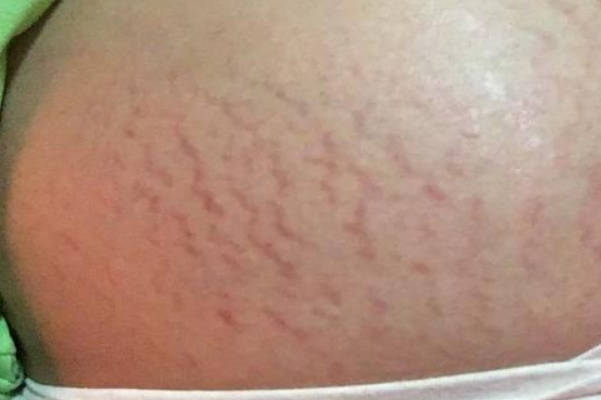 孕妇偏右的妊娠纹集中在腹部右侧