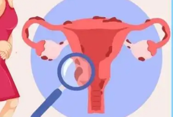子宫内膜异位症做试管前要先调理身体