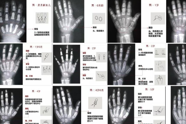 骨密度和骨龄对照表可以查看孩子发育情况