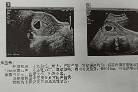 一般男孩有胎芽早还是女孩？2025年4278例研究给出答案