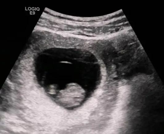 出现孕囊说明胚胎在正常发育