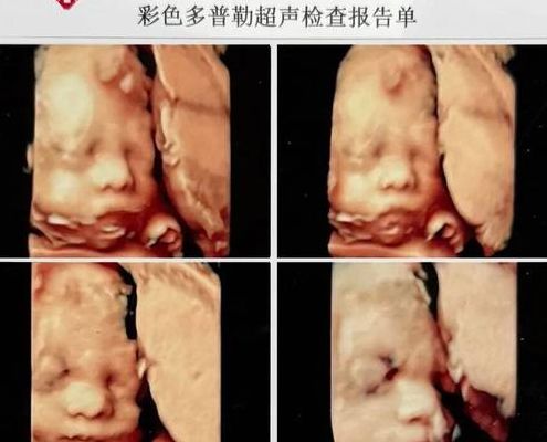 孕23周四维彩超正常值对照表：四维比三维多一维，排畸能力却没多一分