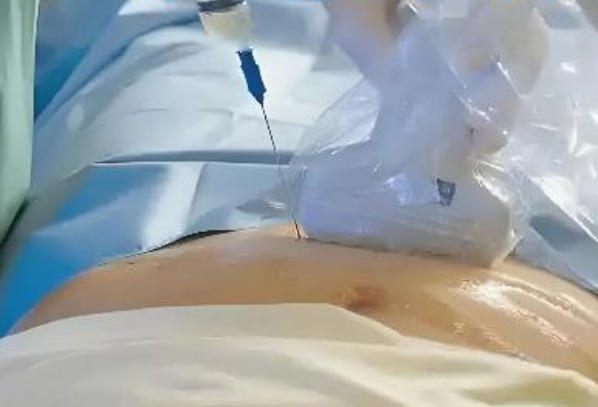 羊水穿刺不是每个孕妇都要做