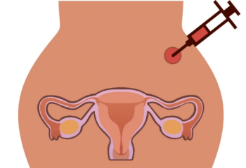 试管打促排针后右侧卵巢有胀痛感严重吗?