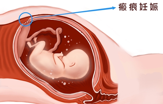 疤痕子宫做试管移植胚胎类型