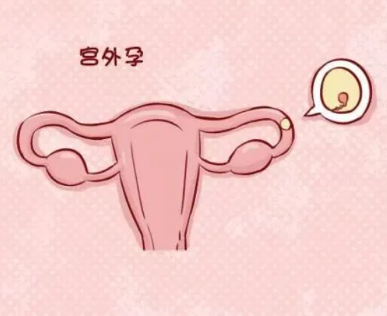移植后多次检查能预防宫外孕
