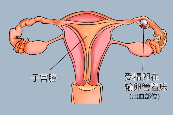 宫外怀孕怎么处理比较安全？确诊后别慌，按这3步走输卵管还有救